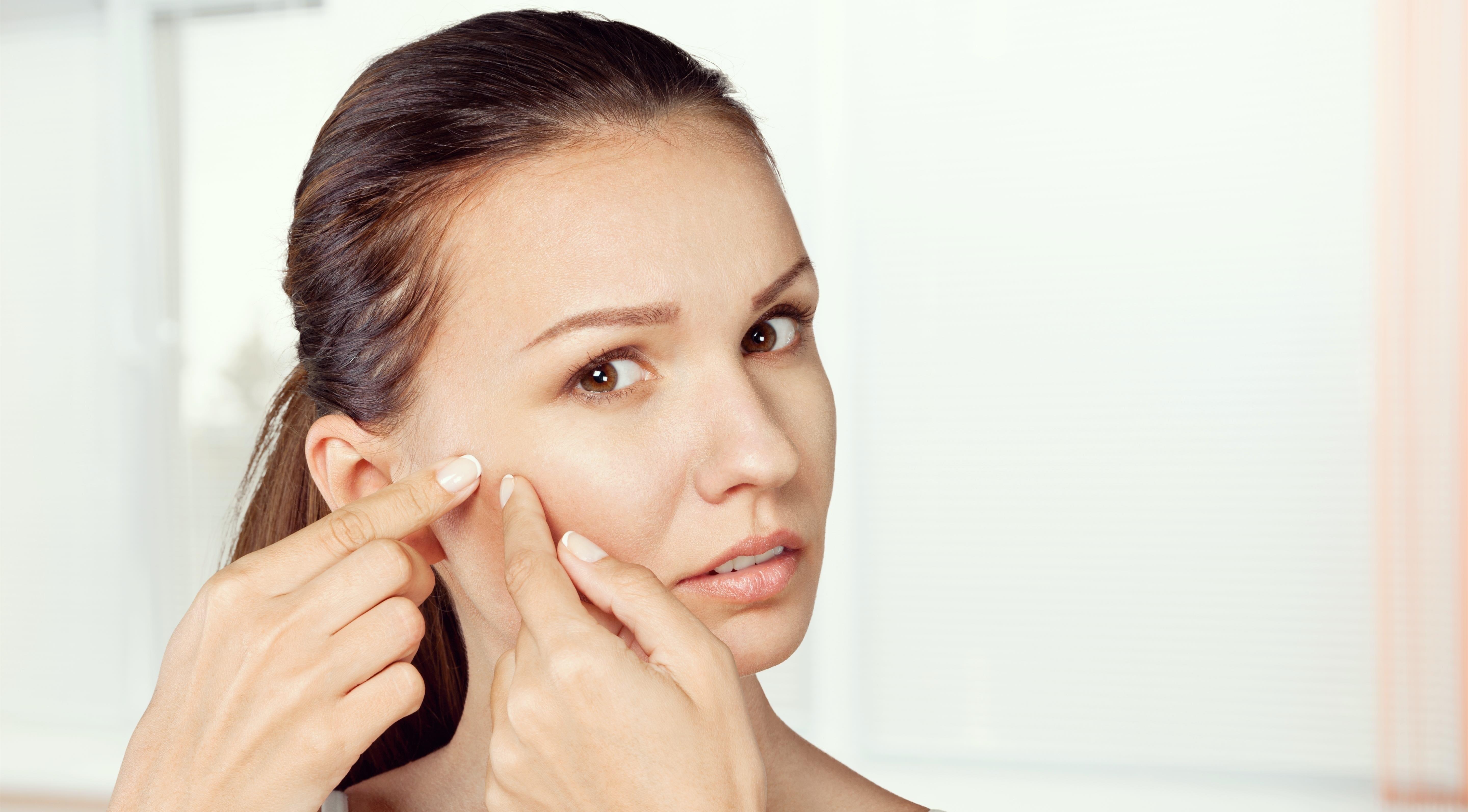 How does eating dairy products impact acne?
