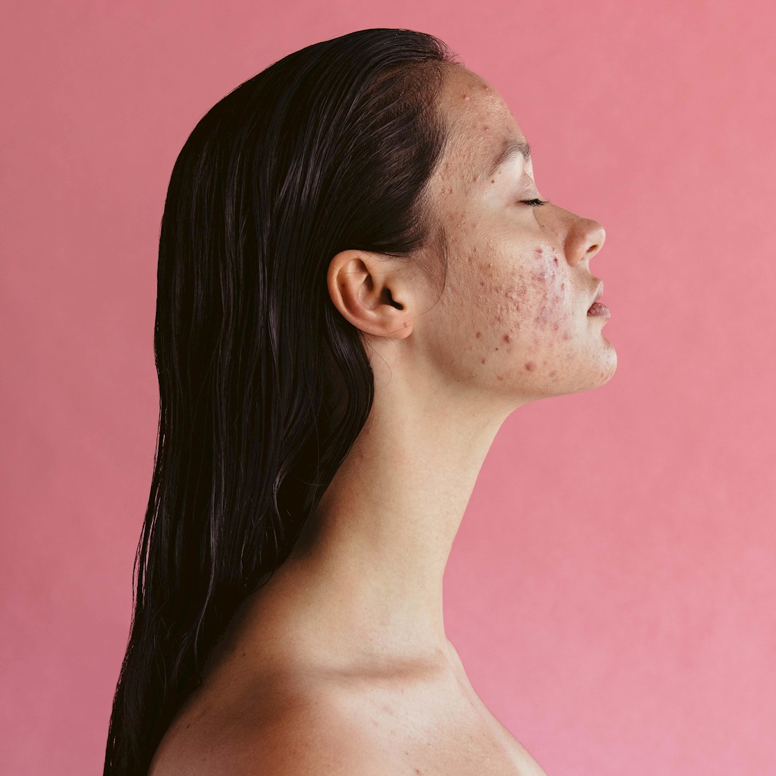 The Purge: Why does skin break out post treatment?