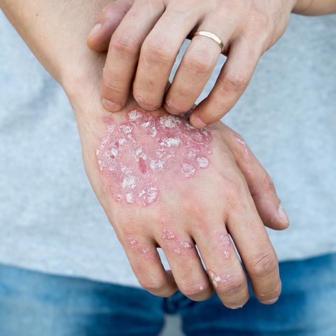 Inflammatory skin conditions have severe impact on quality of life