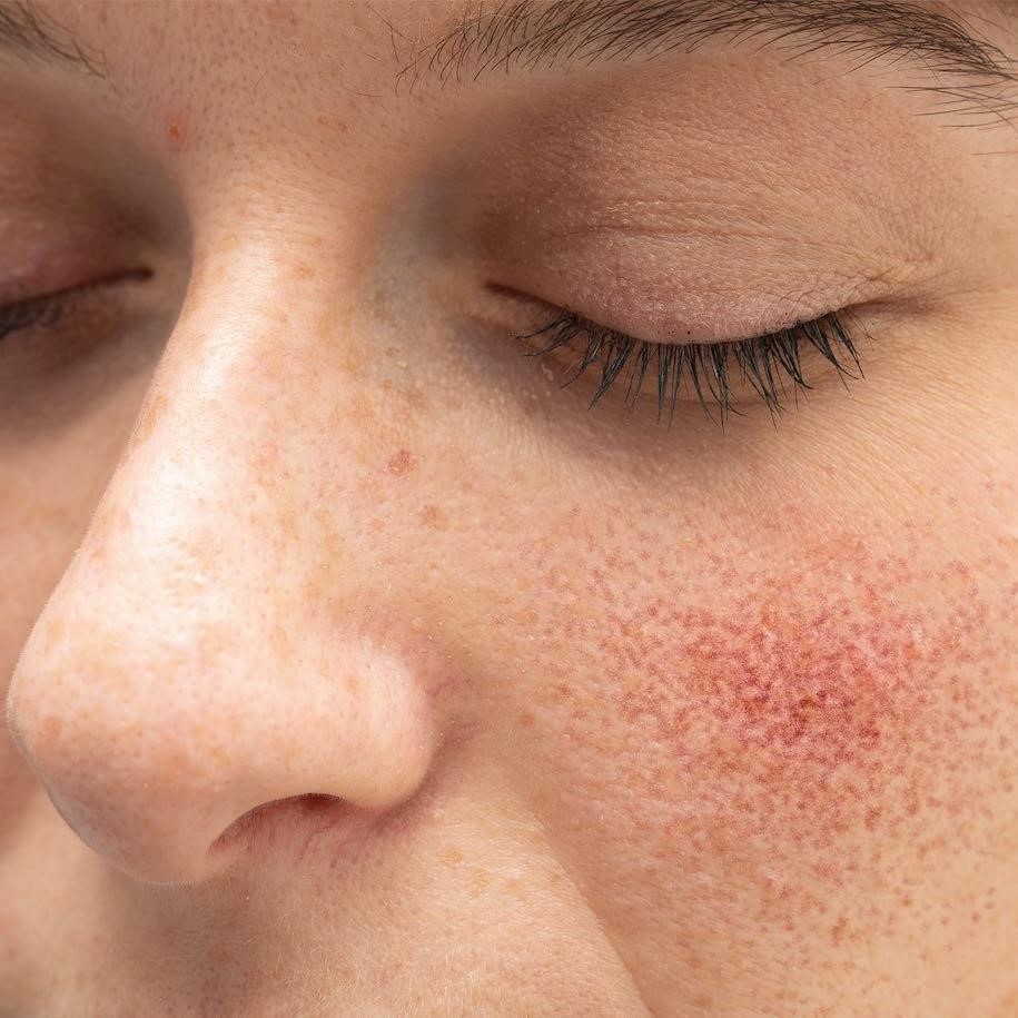 [Updated] Understanding rosacea: causes, symptoms, skincare and treatments