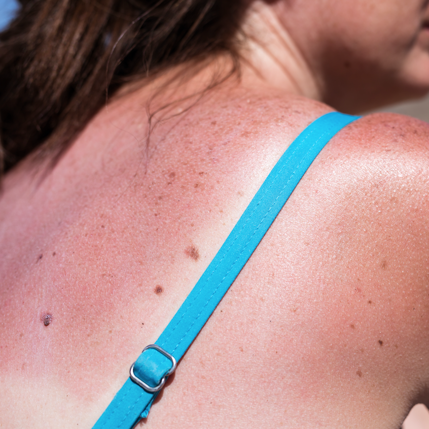 New genes discovered that determine skin's reaction to UV