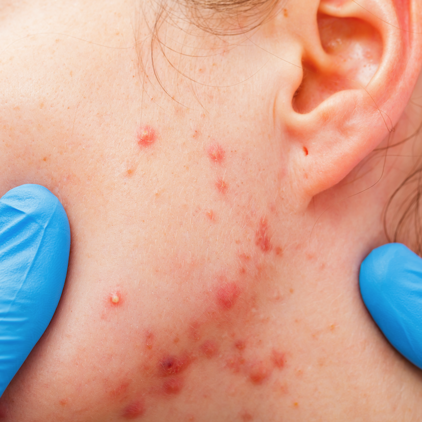 Managing a client's acne journey 