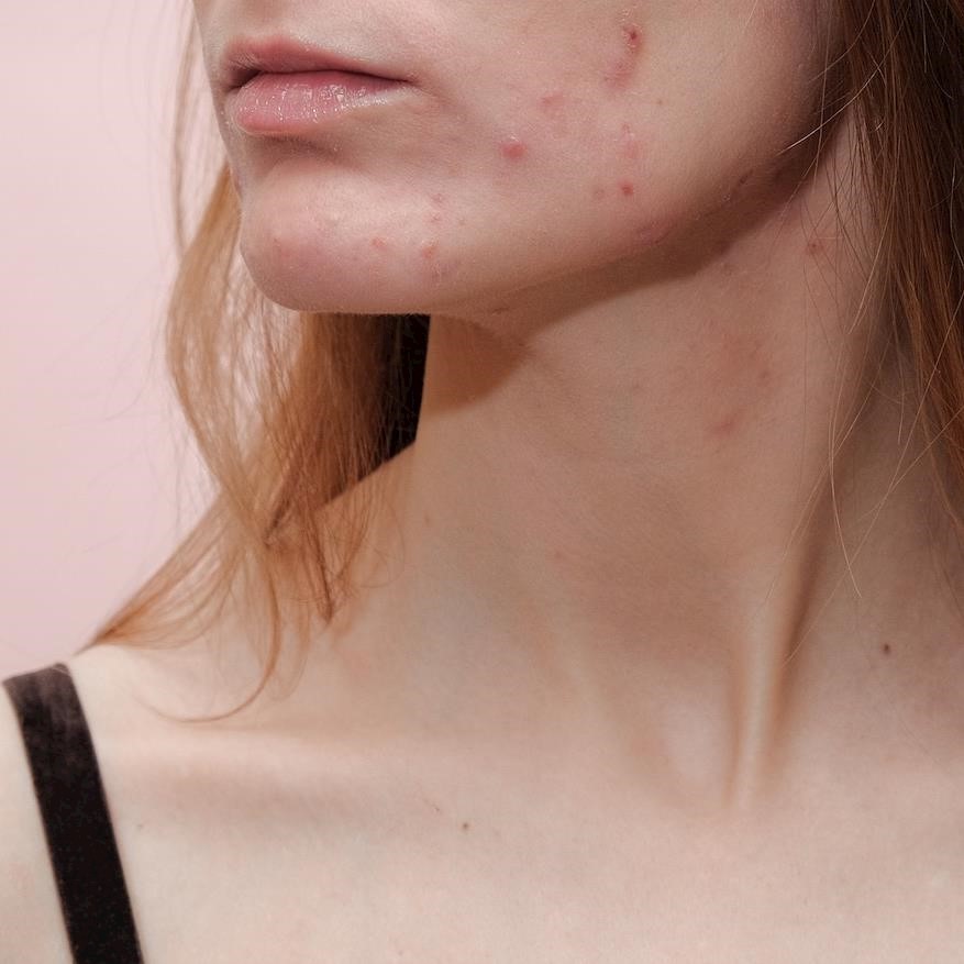 5 skin issues linked to coronavirus identified by dermatologists