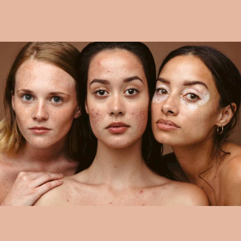 England’s acne hotspots and most skin-friendly regions