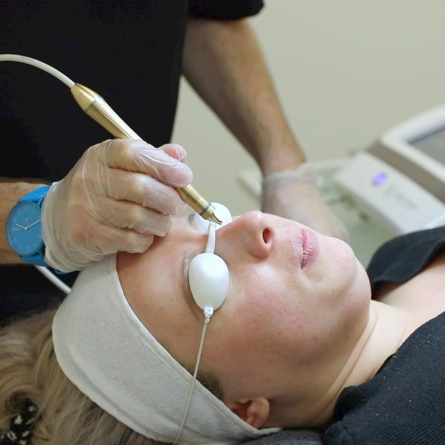 What causes spider veins and how can we remove them?