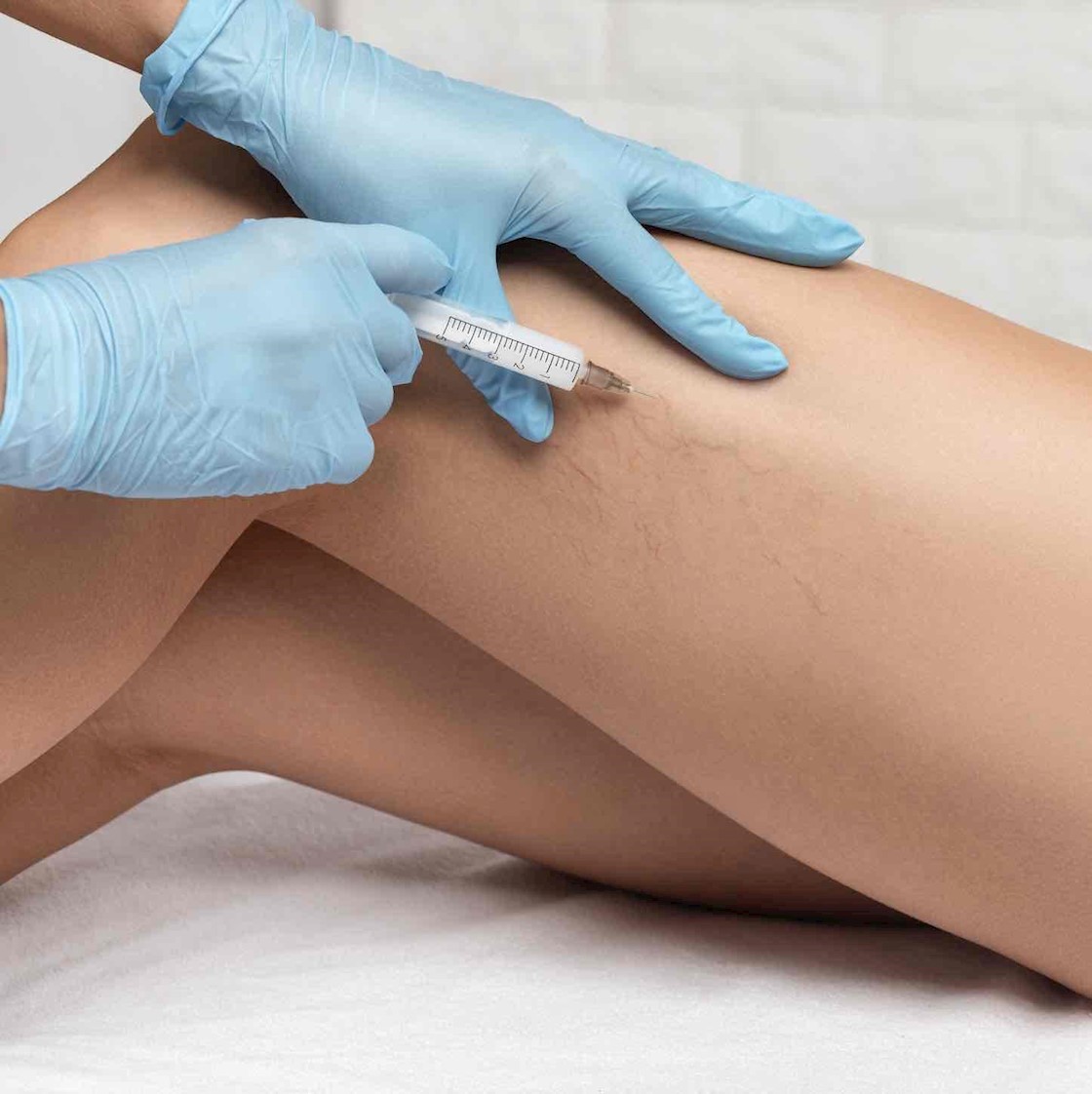 ASA cracks down on beauty salons and clinics advertising sclerotherapy