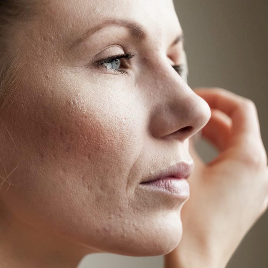 Anti-ageing acne skincare among 2022 aesthetic treatment trends