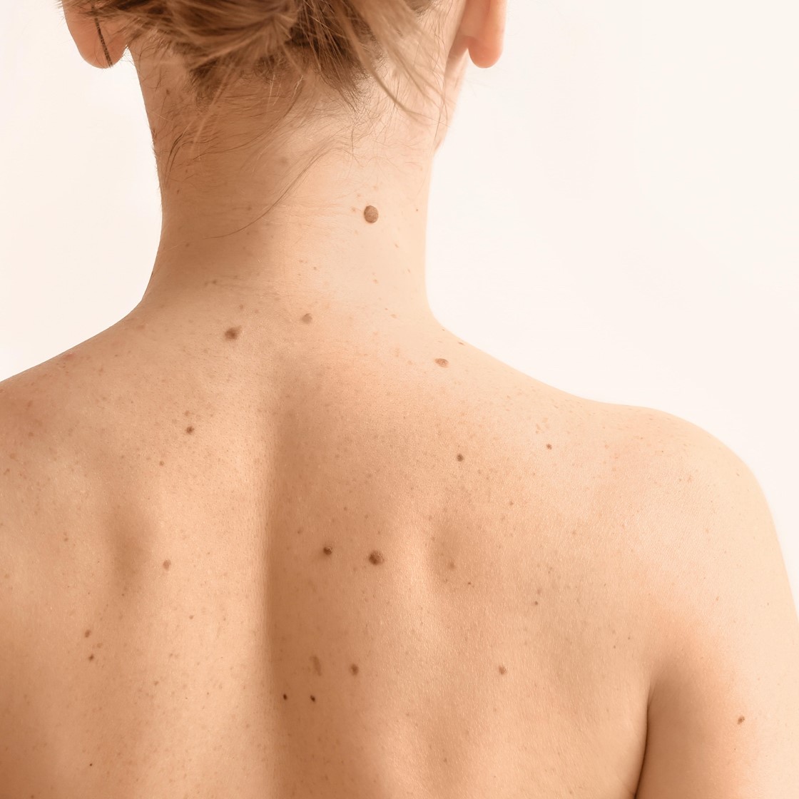 Dermatologists call for ban on pigmentation-removal pens