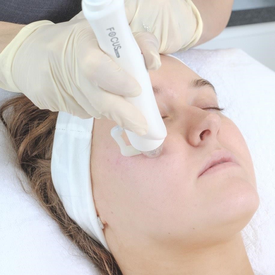 How to treat acne scarring 