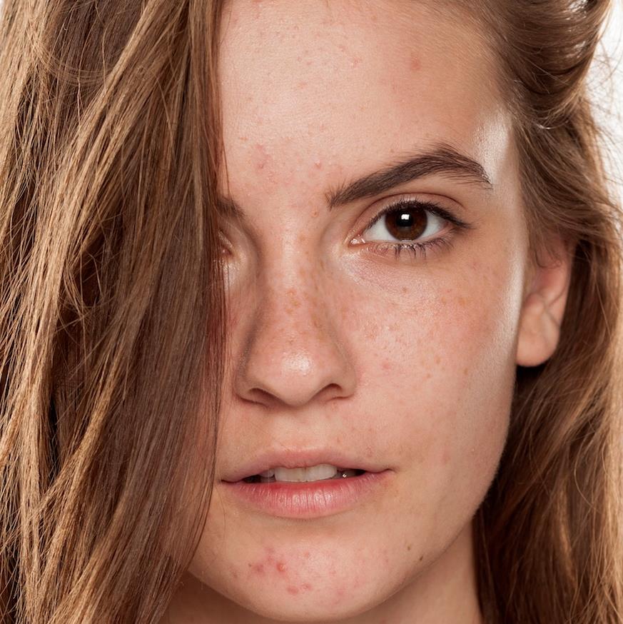 [Updated] How to reduce post-acne pigmentation and scarring