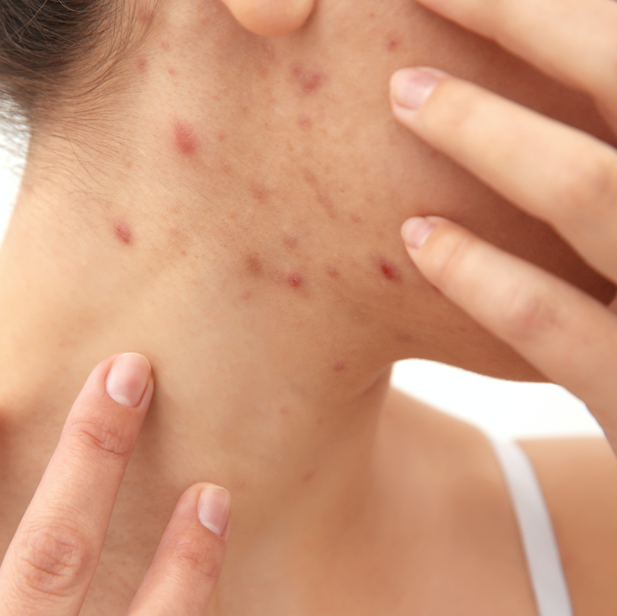 Gold dust treatment could provide solution for acne sufferers