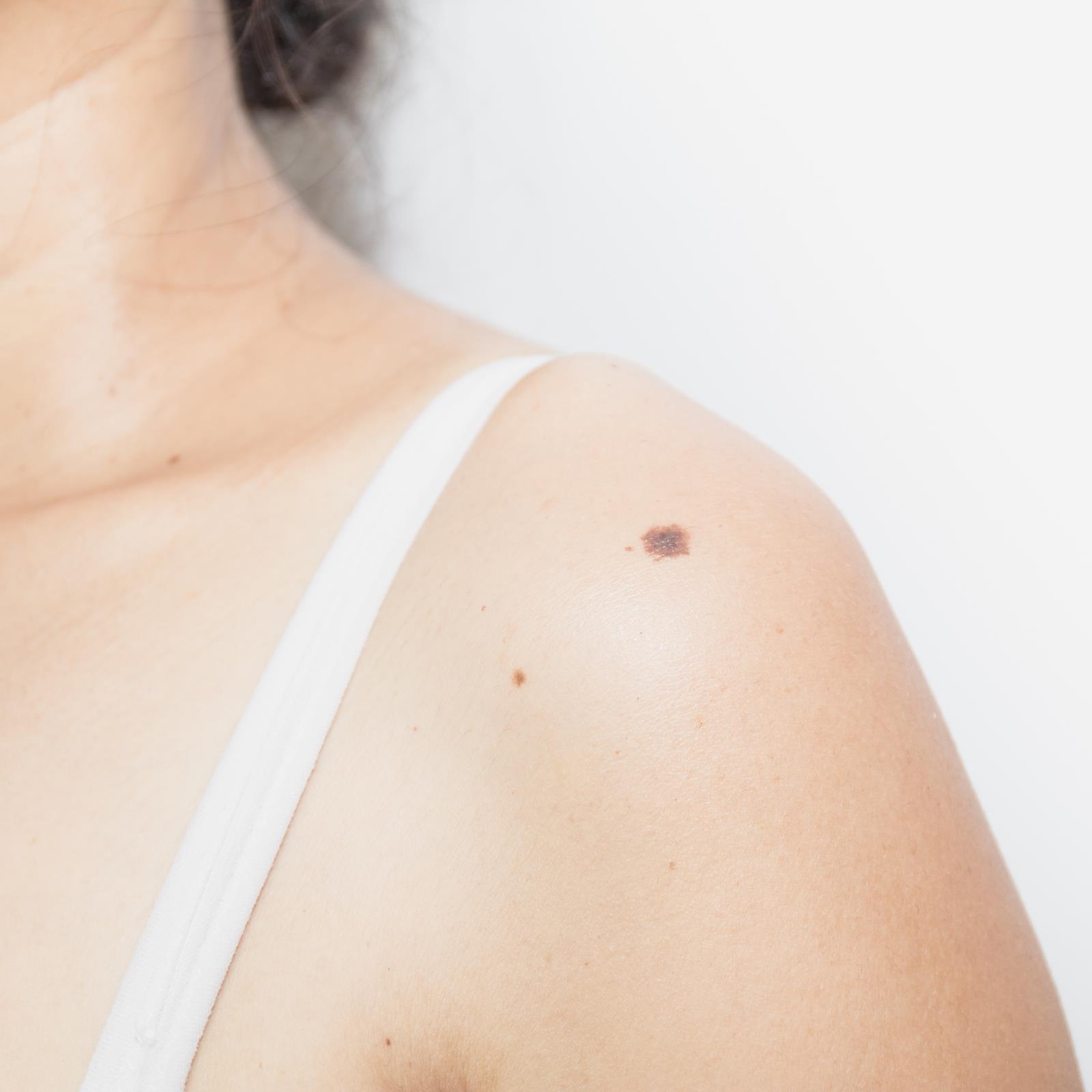 Beauty therapist saves four clients' lives after spotting cancerous moles