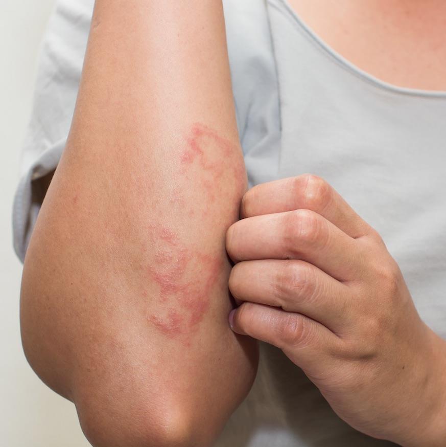 Could molecule CD1a be the key to preventing contact dermatitis?