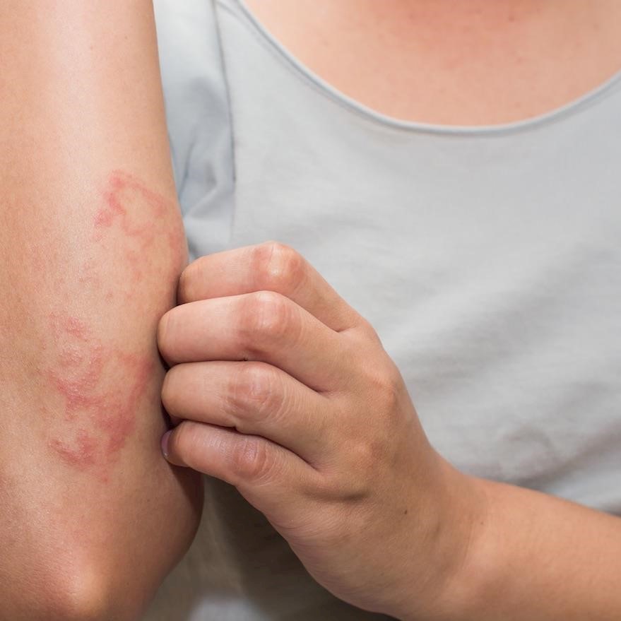 Online searches for eczema and acne decreased during Covid-19 lockdown