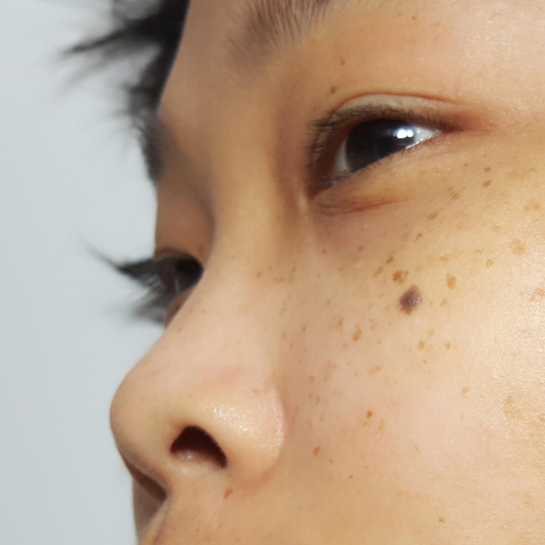Why pigmentation appears differently on some skin tones