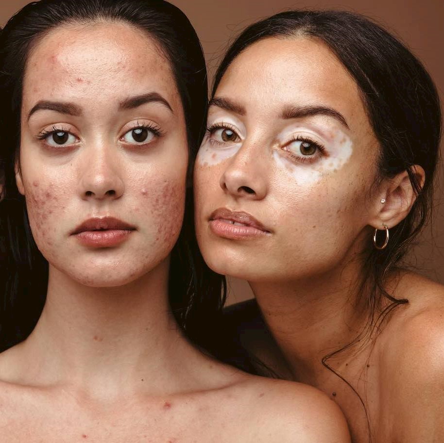 62% of young adults say social media makes them feel worse about their skin