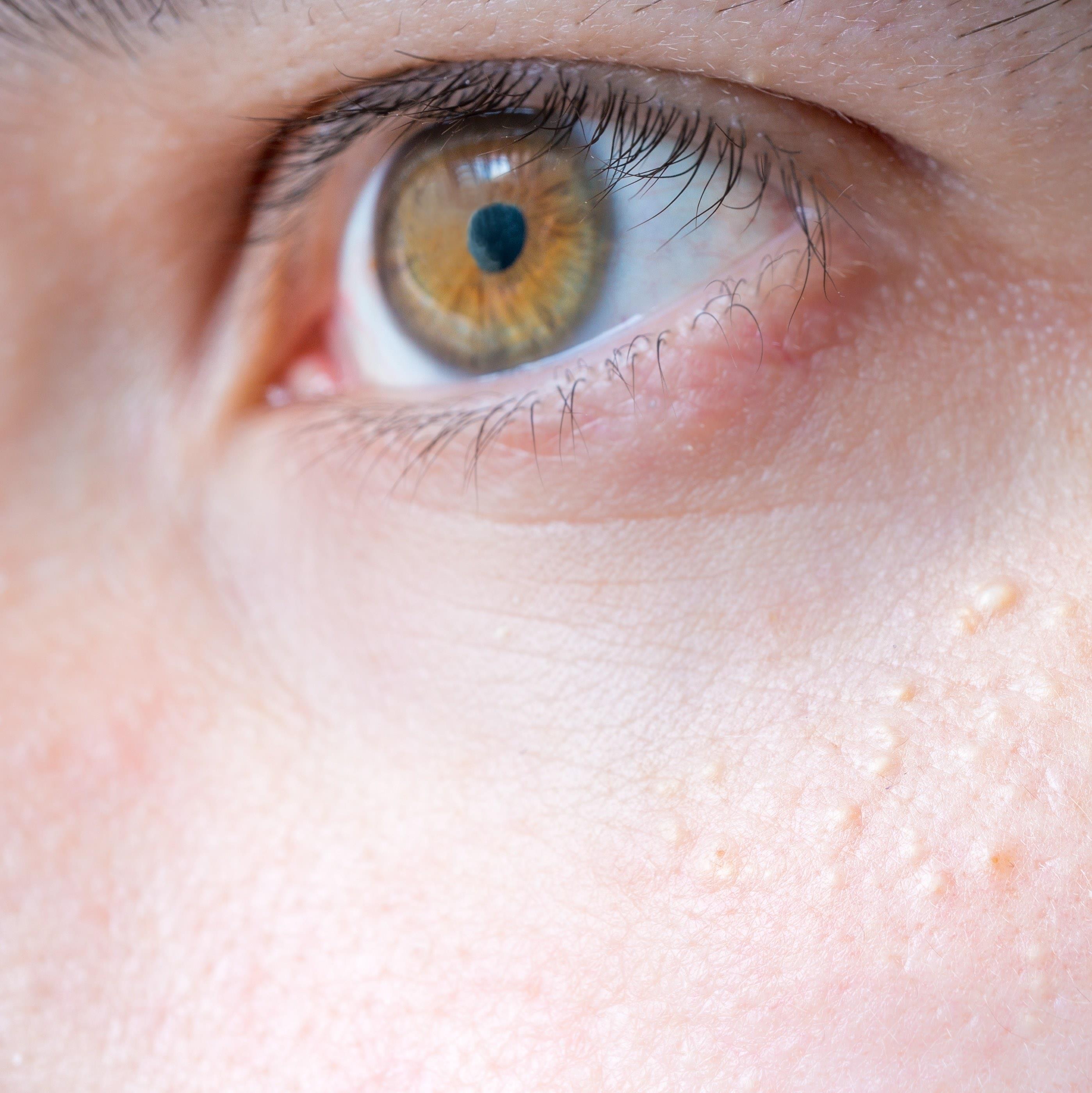 How to treat clients with milia 