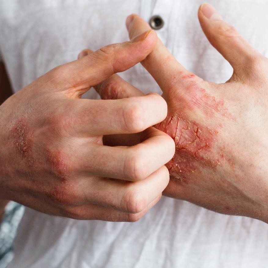 37% of eczema sufferers say the condition affects their confidence daily