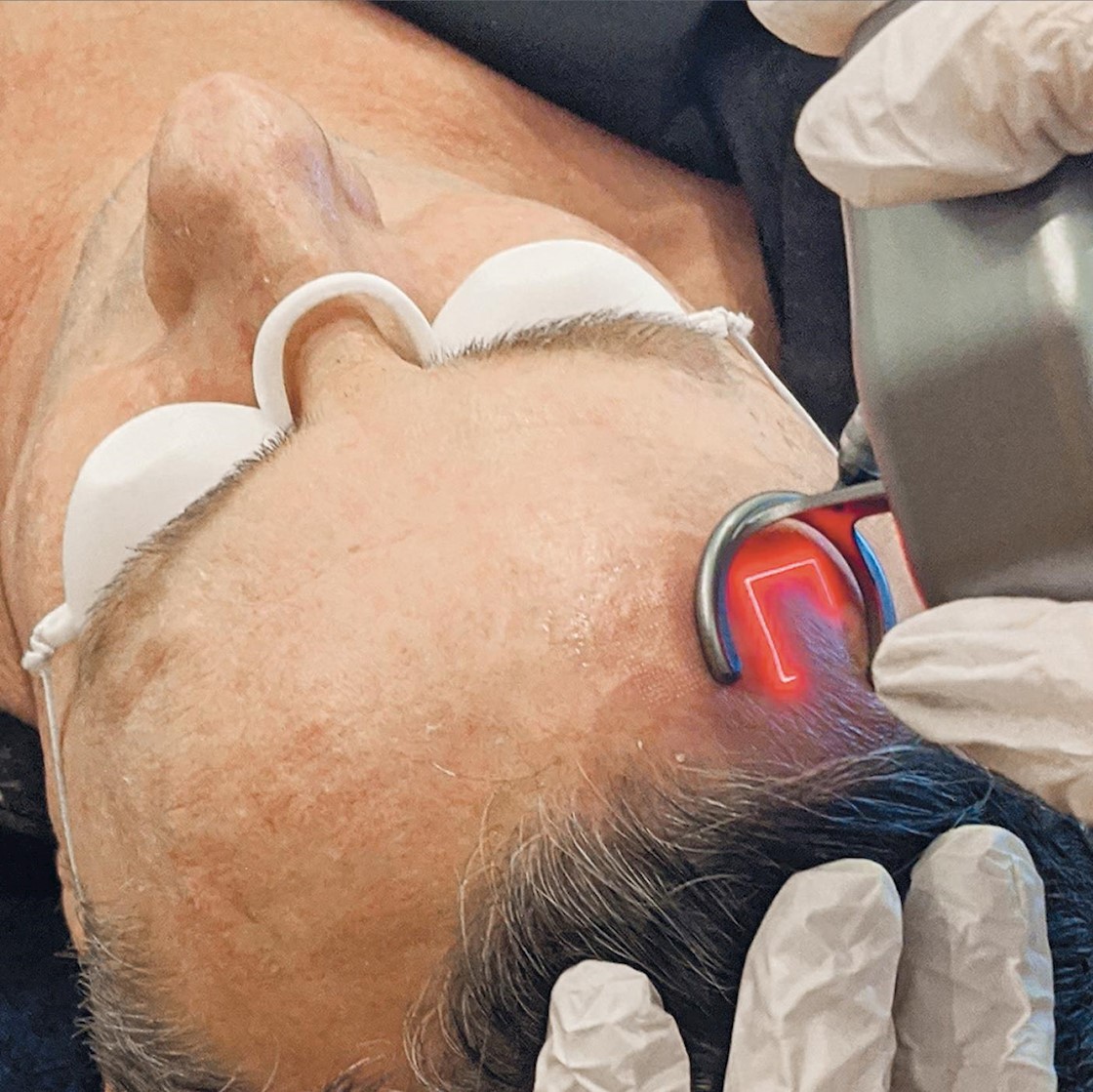 What is CO2 laser resurfacing and how does it work?