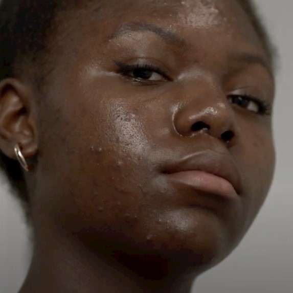 Revealed: impact of skin conditions acne and eczema on people's mental health