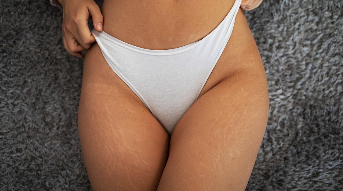 [Updated] Spray tanning clients with scars and stretch marks