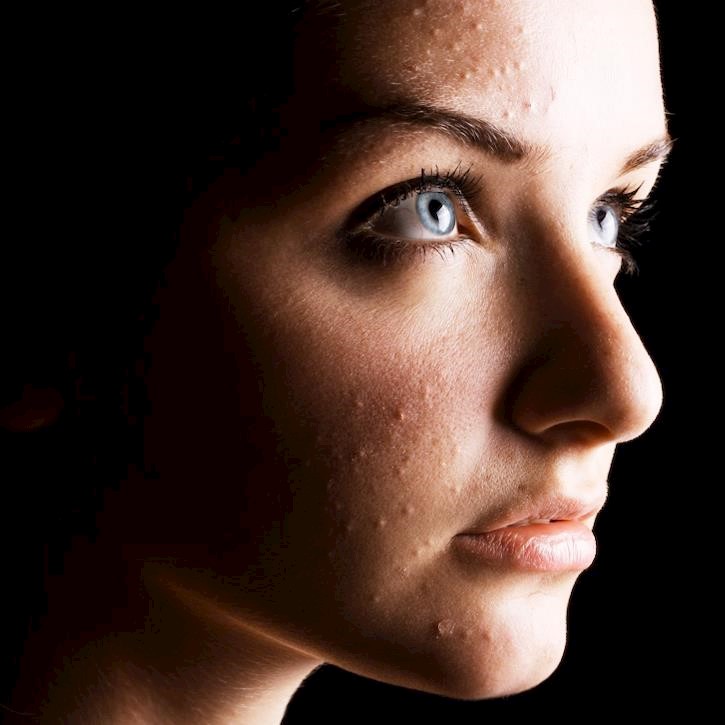 A third of people with a skin condition say it affects their mental health 