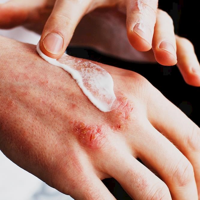 Topical steroid withdrawal TSW campaign launched to raise awareness in eczema and psoriasis sufferers