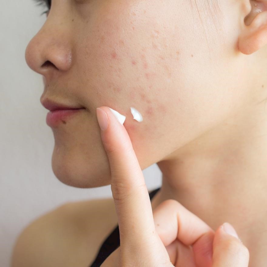 New TV programme explores skin disease, skin stigma and mental health