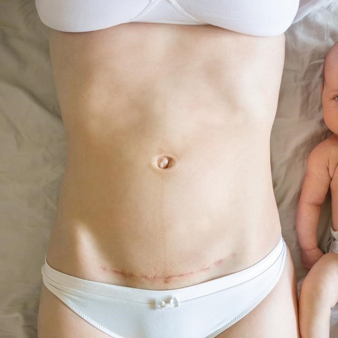 Treating caesarean section scars