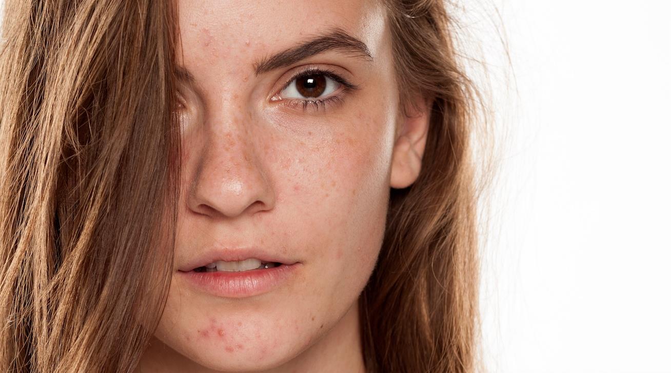 [Updated] How to reduce post-acne pigmentation and scarring