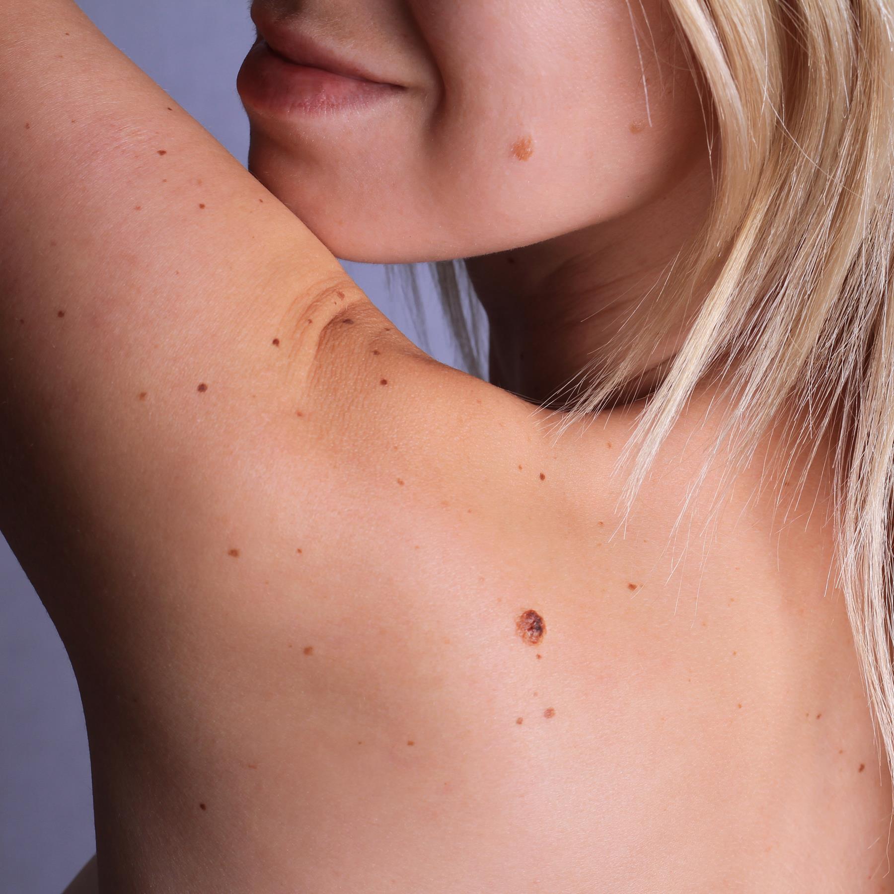 The best ingredients for treating brown spots