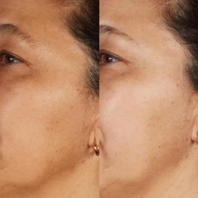 Tackling pigmentation with skincare