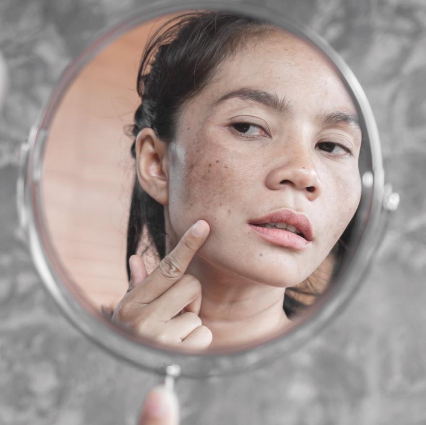 Hyperpigmentation vs melasma: causes, symptoms and best treatment
