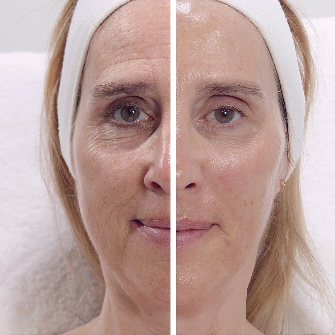 Non-invasive treatments for rejuvenating skin