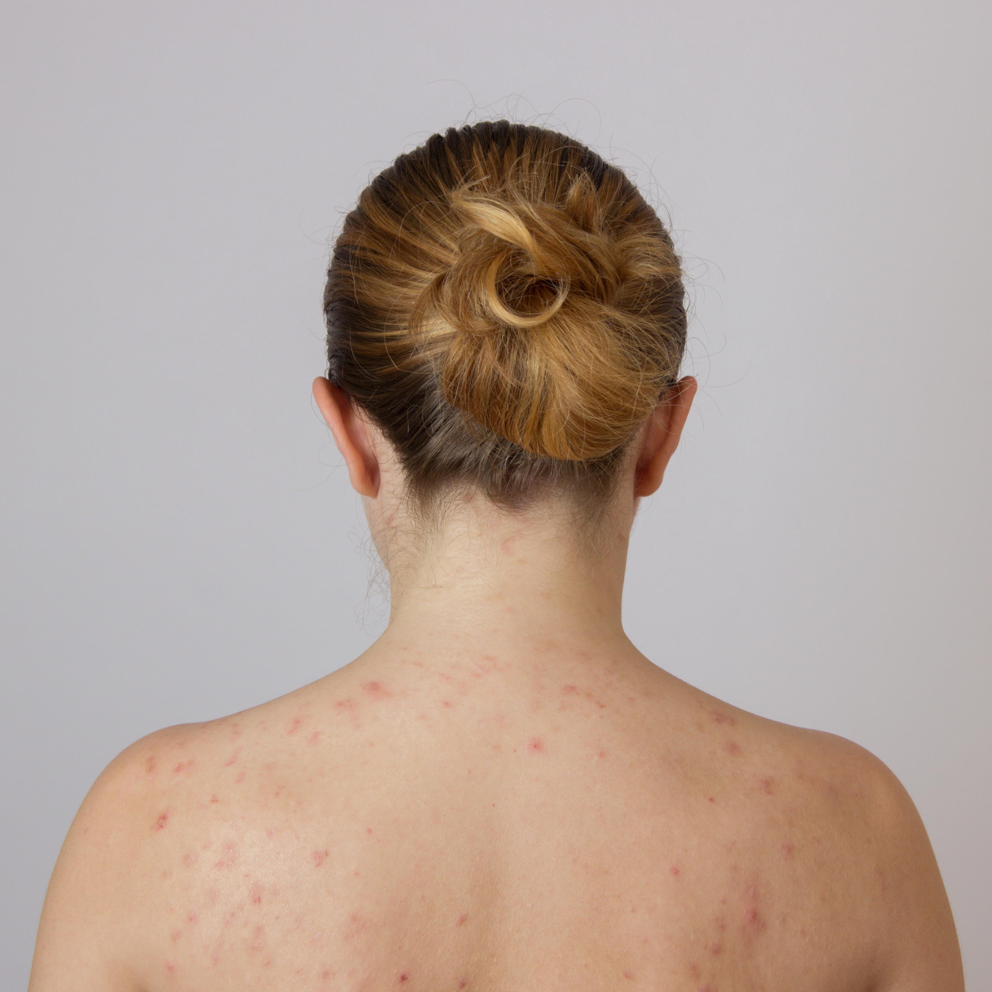 How to treat bacne in salon