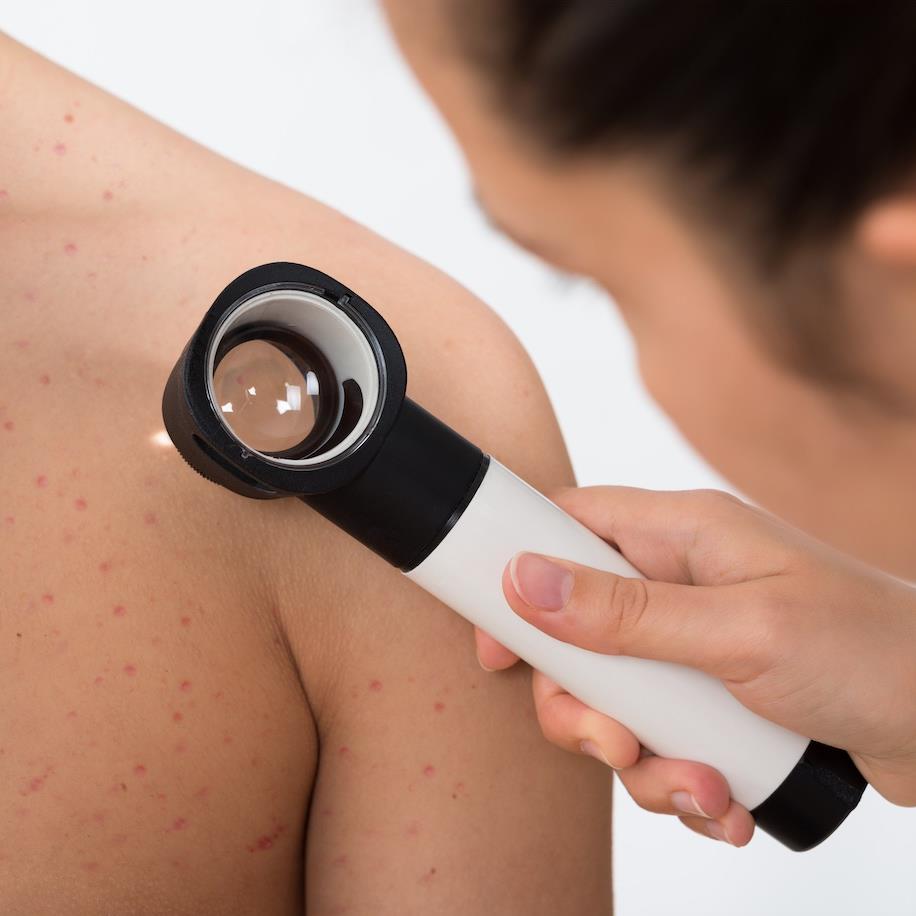 Pioneering melanoma test to be available on NHS within two years
