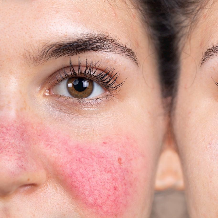 3 ways to treat rosacea in salon