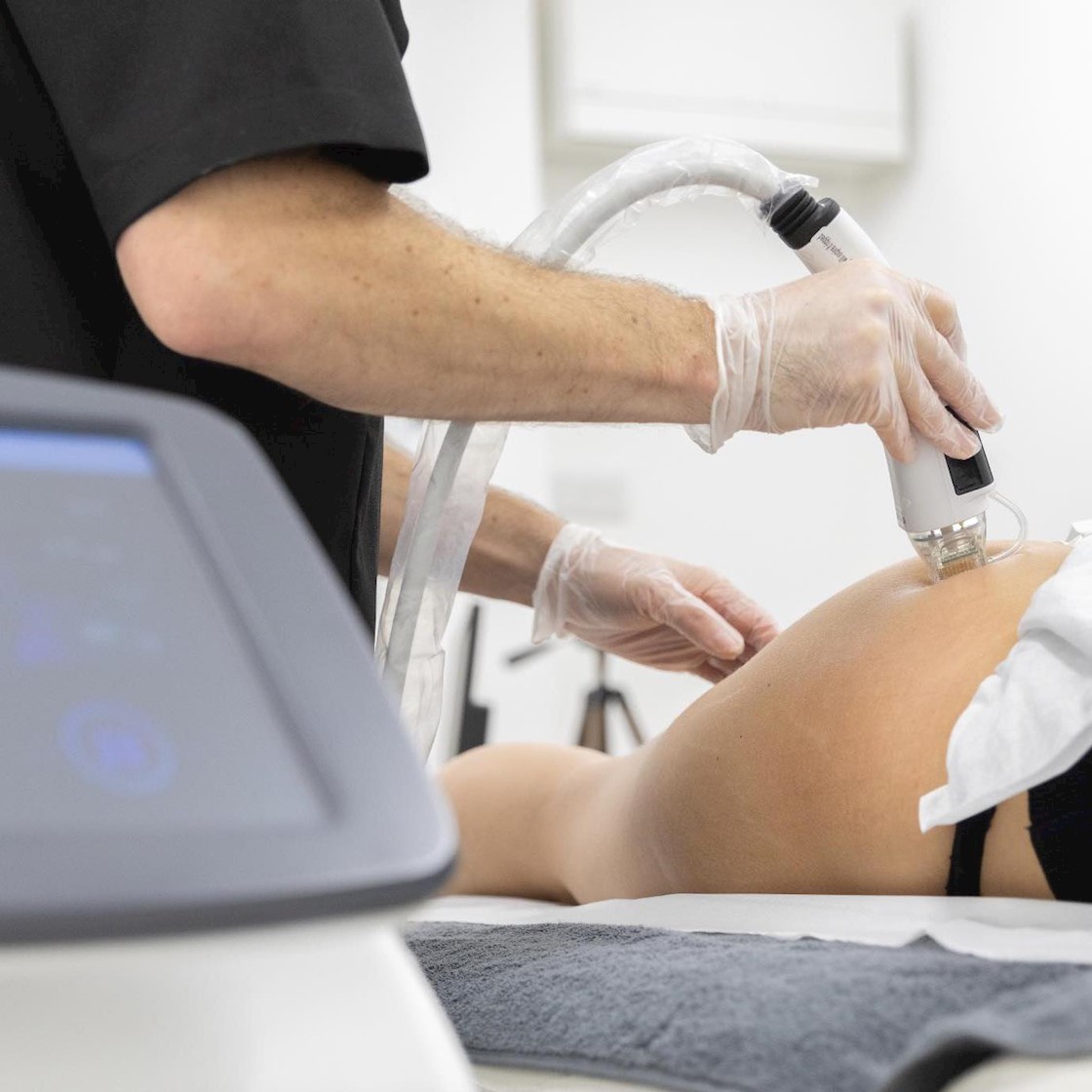 How to treat stretch marks with microneedling and radiofrequency