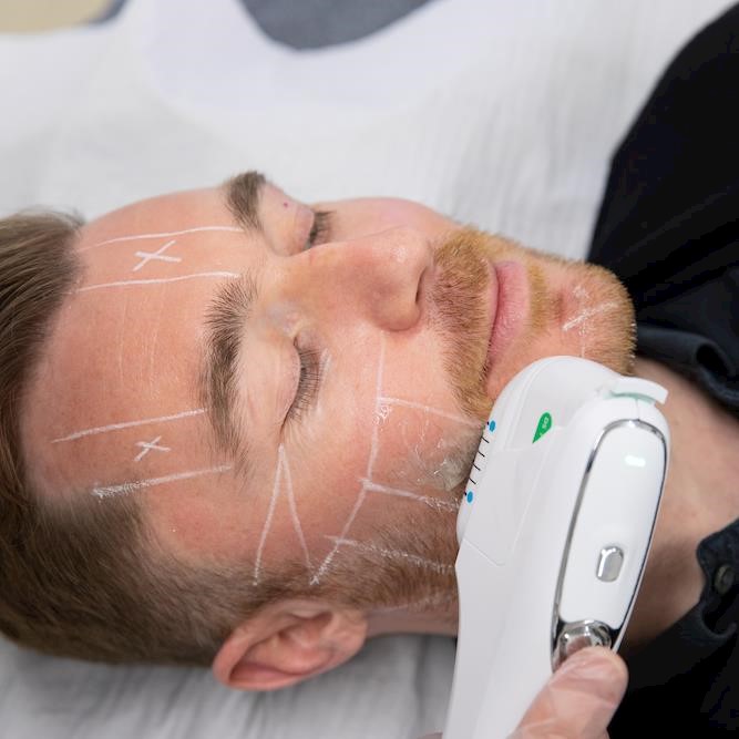 HIFU: The ultimate non-invasive alternative for male skin tightening