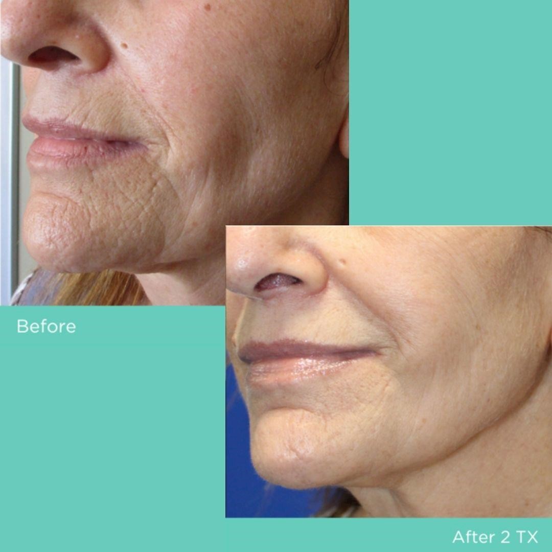 Radiofrequency set to be among most in-demand treatments post lockdown