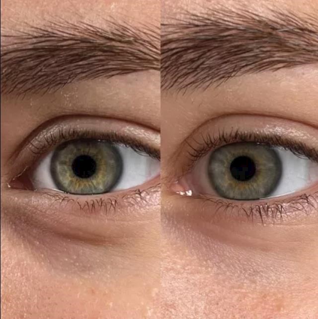 Using skincare to treat signs of dark circles