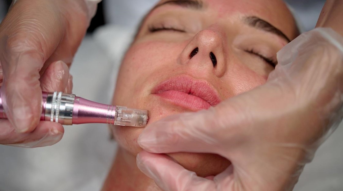[Updated] The differences between mesotherapy and microneedling