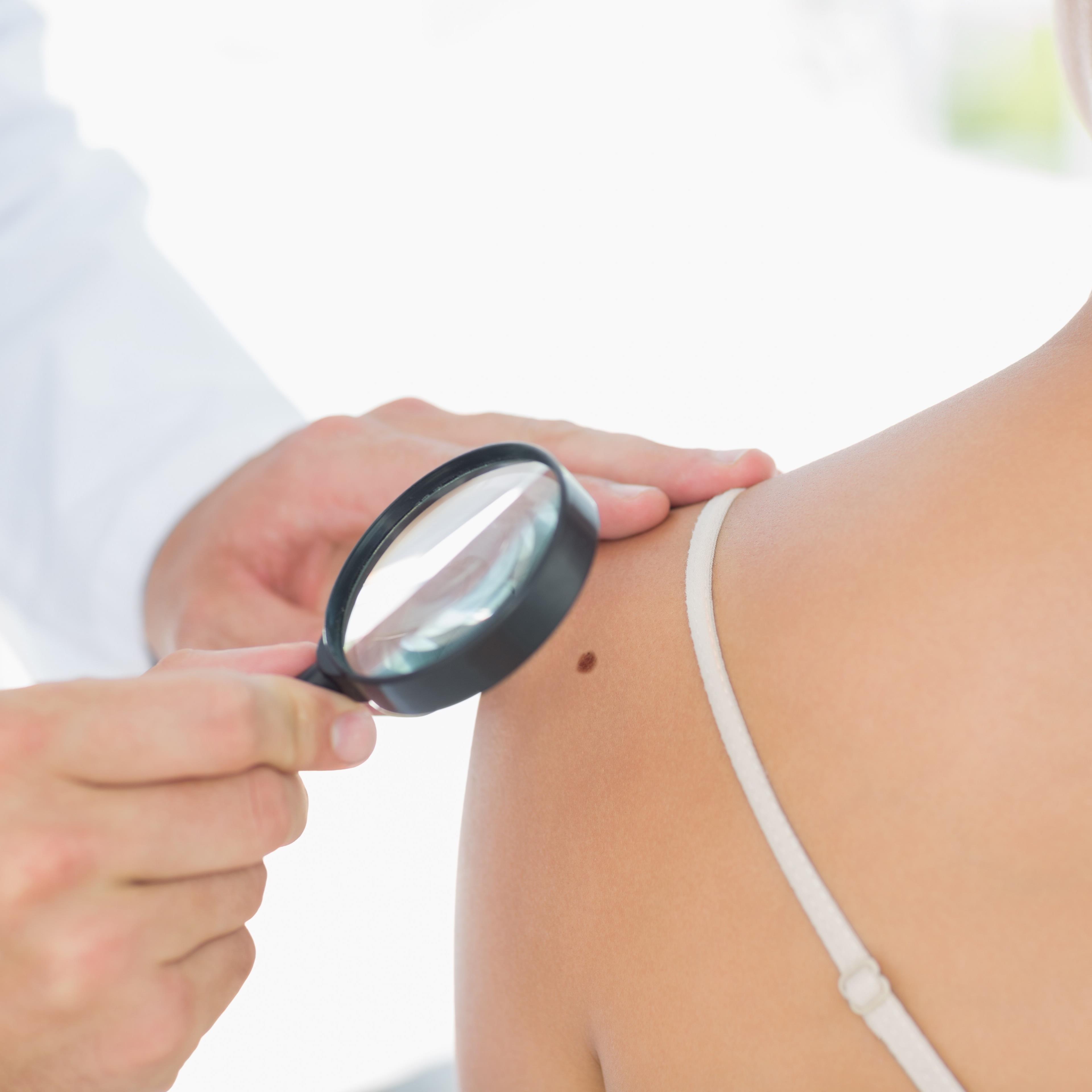 Quarter of Brits have never checked for skin cancer 