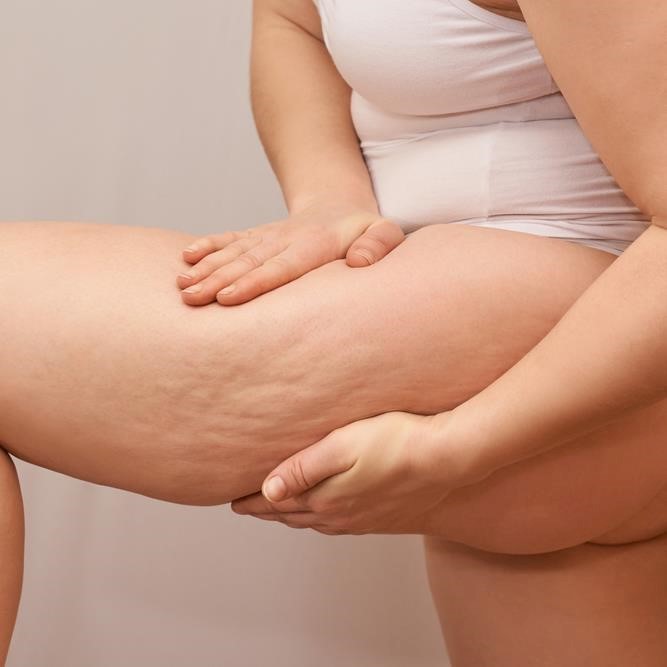 Smoothing cellulite: the best non-invasive devices