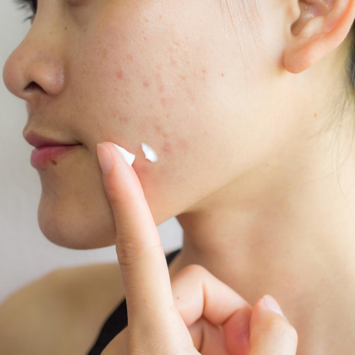 How vitamin A works on acne-prone skin