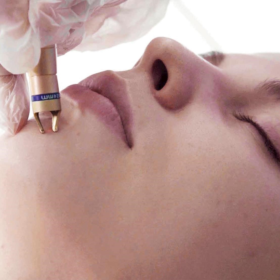 New laser device launches for the effective removal of thread veins